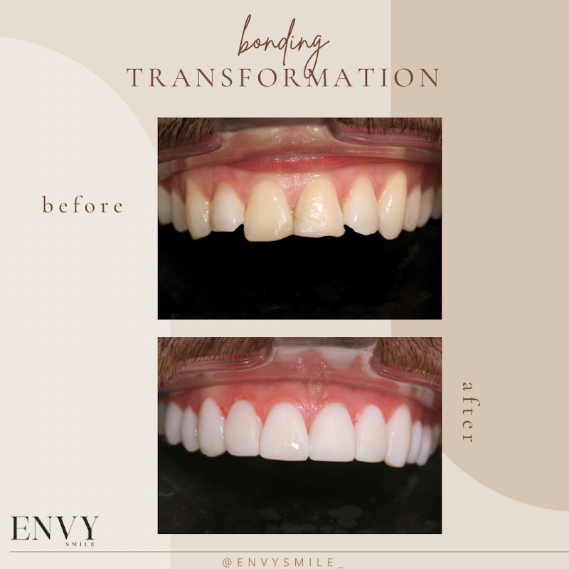Envy Smile Dental & Aesthetics | Composite Bonding London